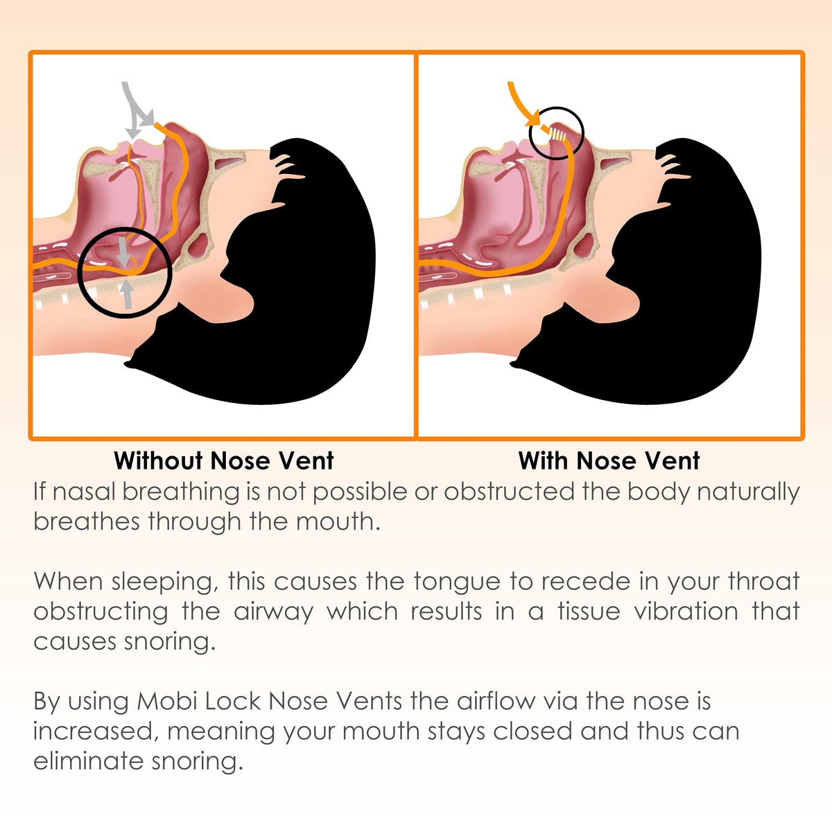Anti-Snoring Device for Men & Women